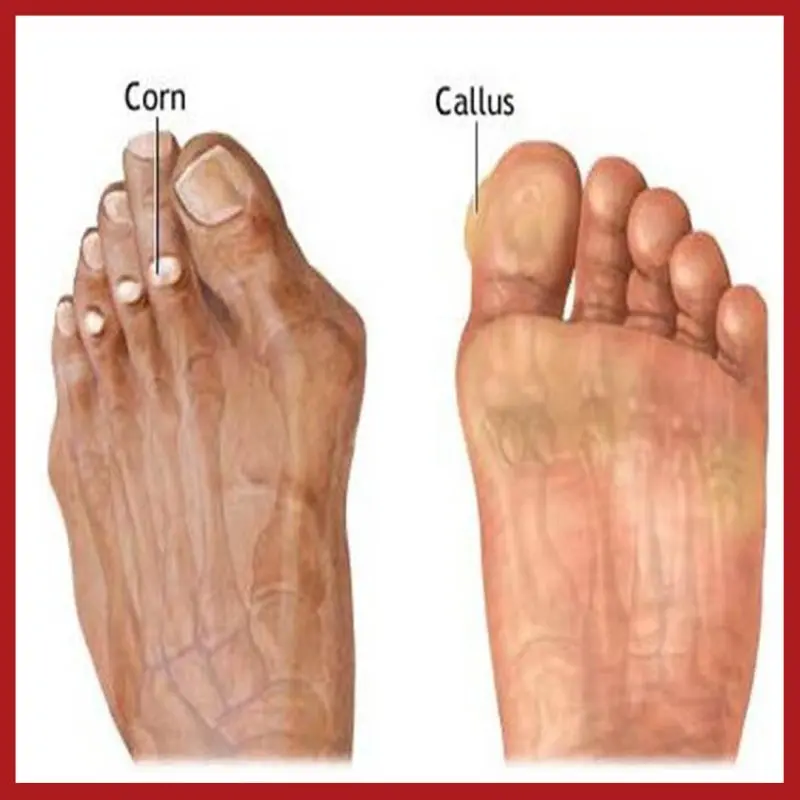 The callus, how to treat it?