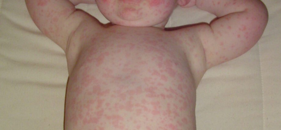 The child has a rash without fever: small and red, itching, reasons for what to do