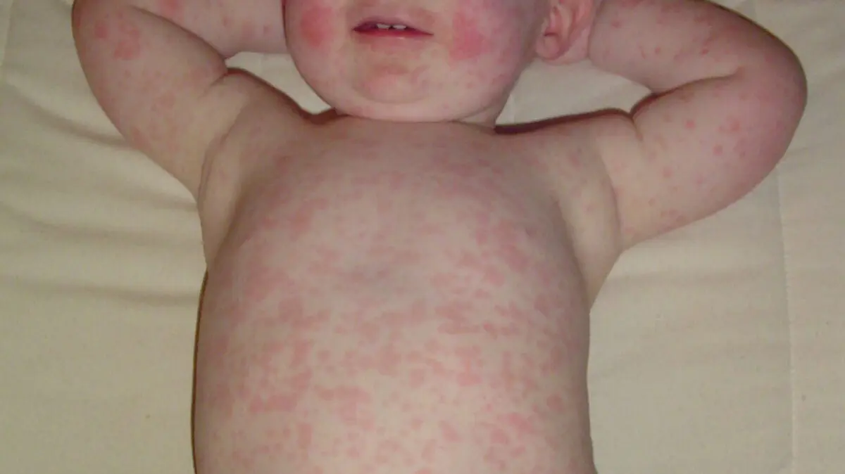 The child has a rash without fever: small and red, itching, reasons for what to do