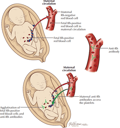 The child received 6 blood transfusions in the womb