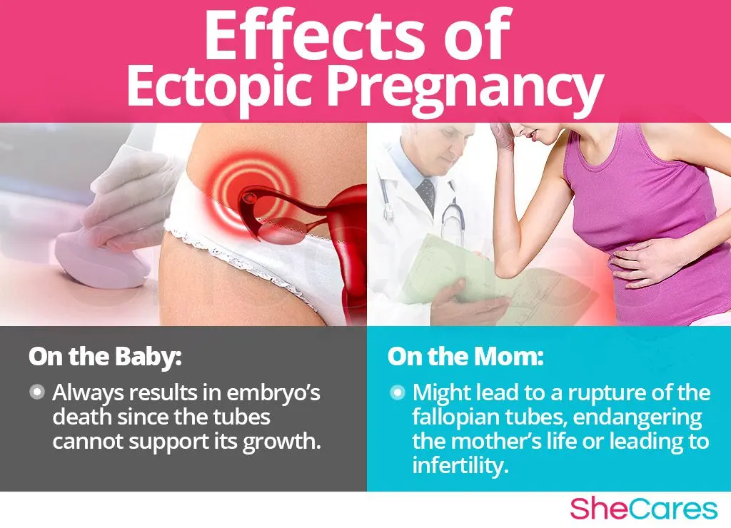 The consequences of an ectopic pregnancy