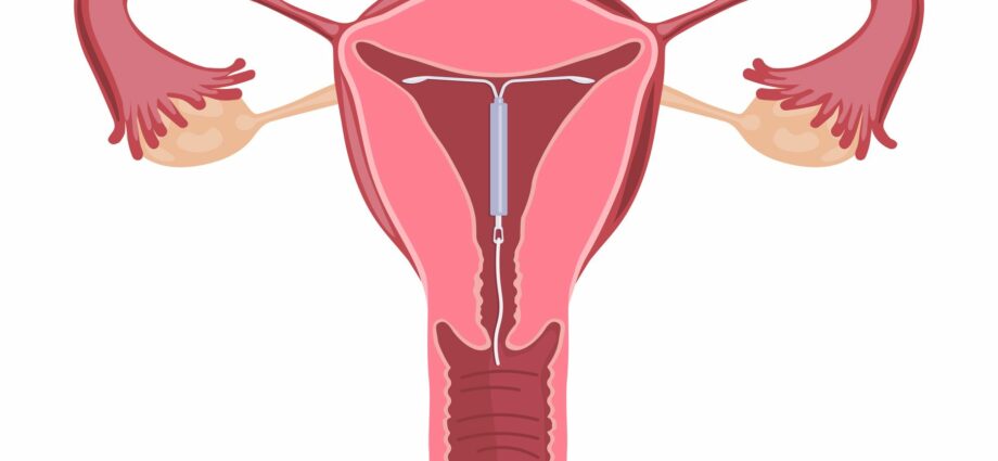 Ang tanso IUD (IUD): kahusayan at pag-install