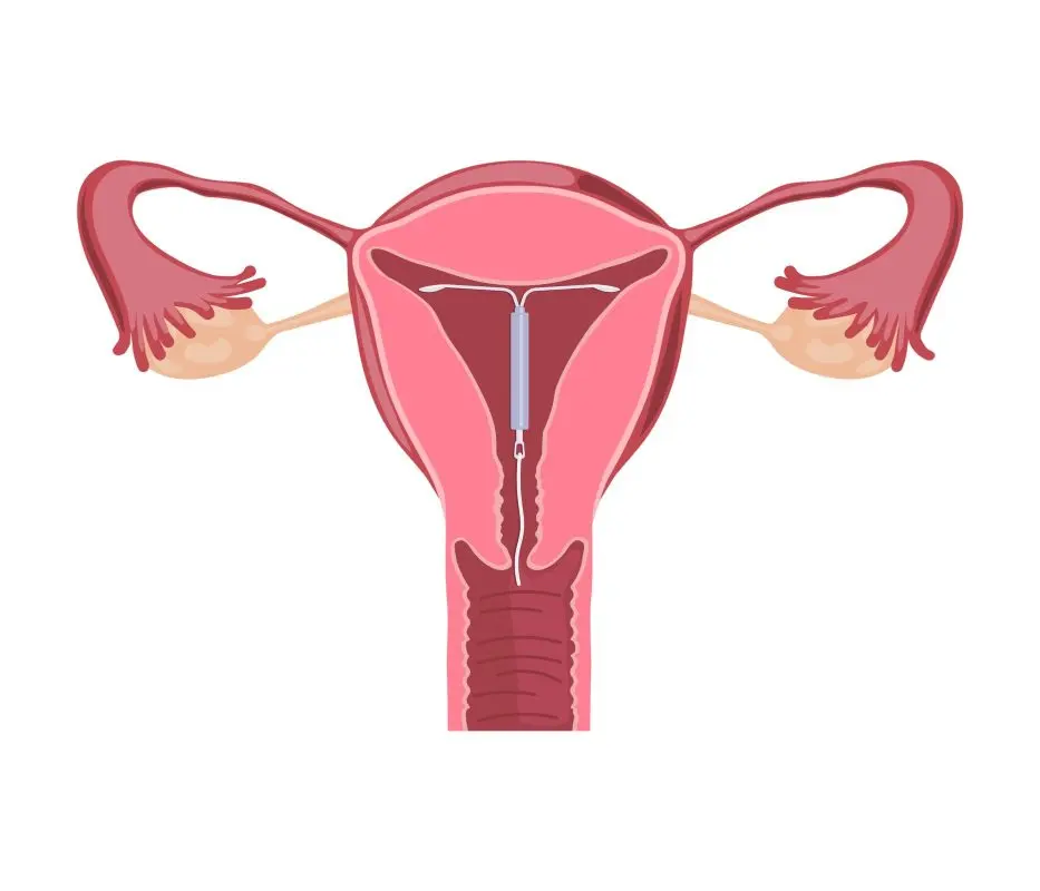 The copper IUD (IUD): efficiency and installation