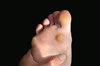 The corns on the feet (in other words, the hardened areas of the skin on the soles of the feet) deliver a lot of unpleasant sensations. However, there are many effective ways to treat corns.