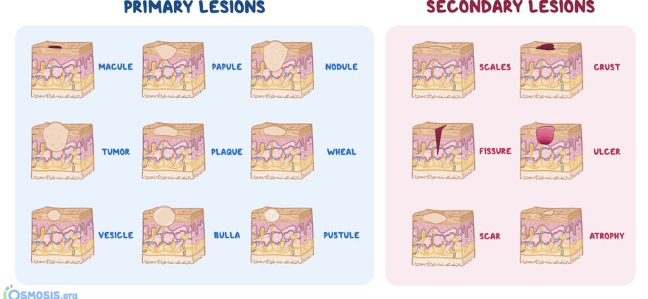 The different lesions