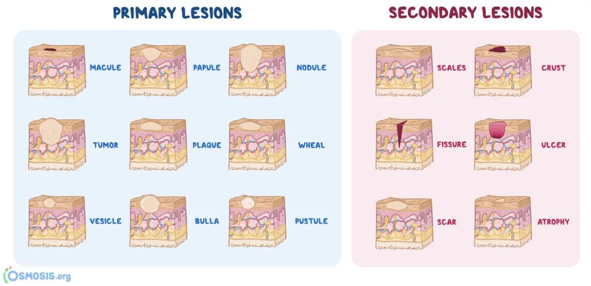 The different lesions