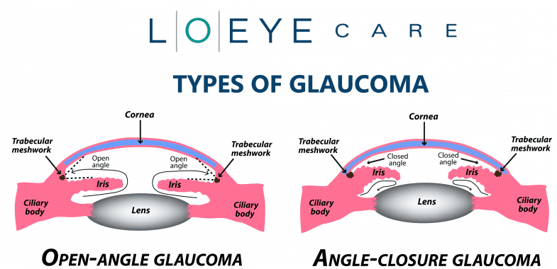 The different types of glaucoma