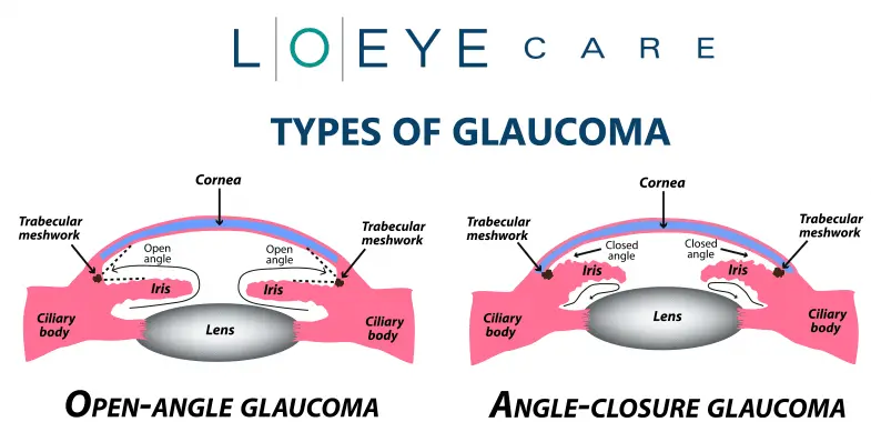 The different types of glaucoma