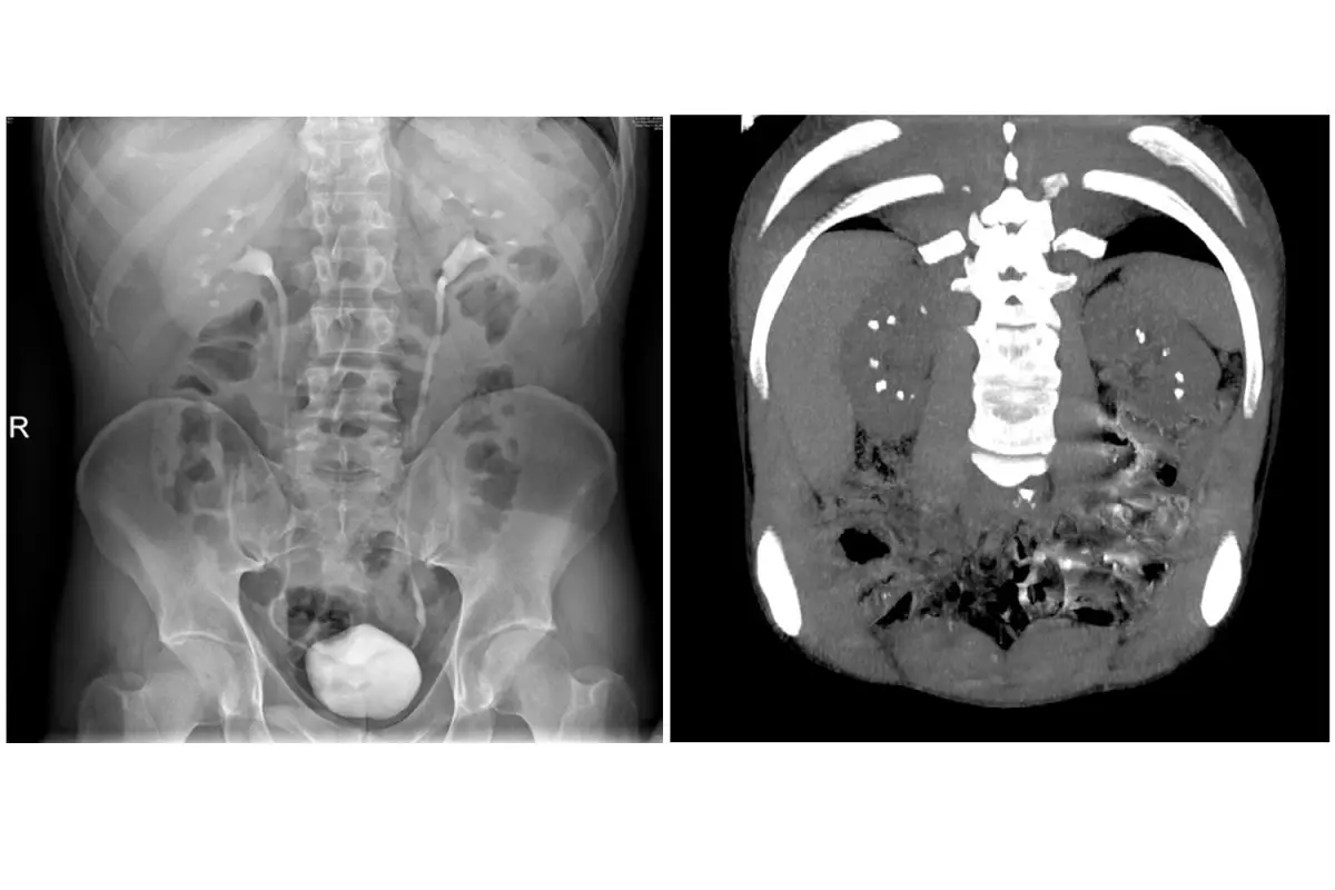 The disease of Cacchi and Ricci