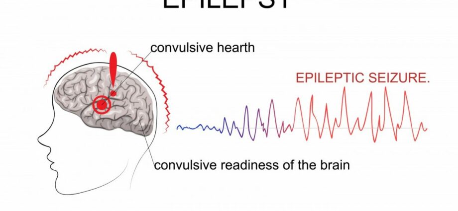 Ang epileptic seizure