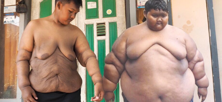 世界上最胖的孩子瘦了30公斤