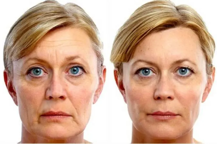 The impossible is possible: a circular facelift without surgery