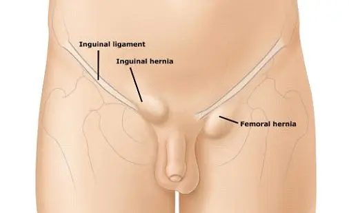 The lump or lump in the groin