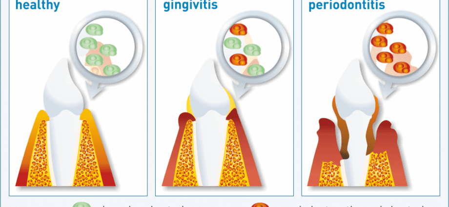 A periodontite