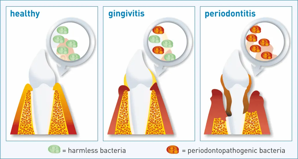 The periodontitis