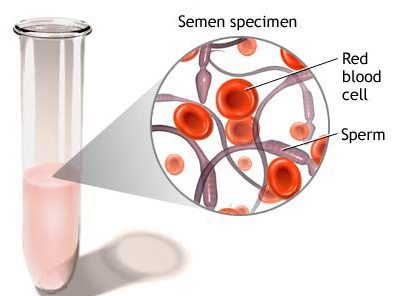 Kraujo buvimas spermoje