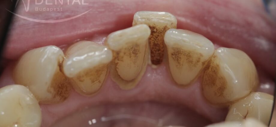Prevencia zubného kameňa (tvorba vodného kameňa a zubný povlak)