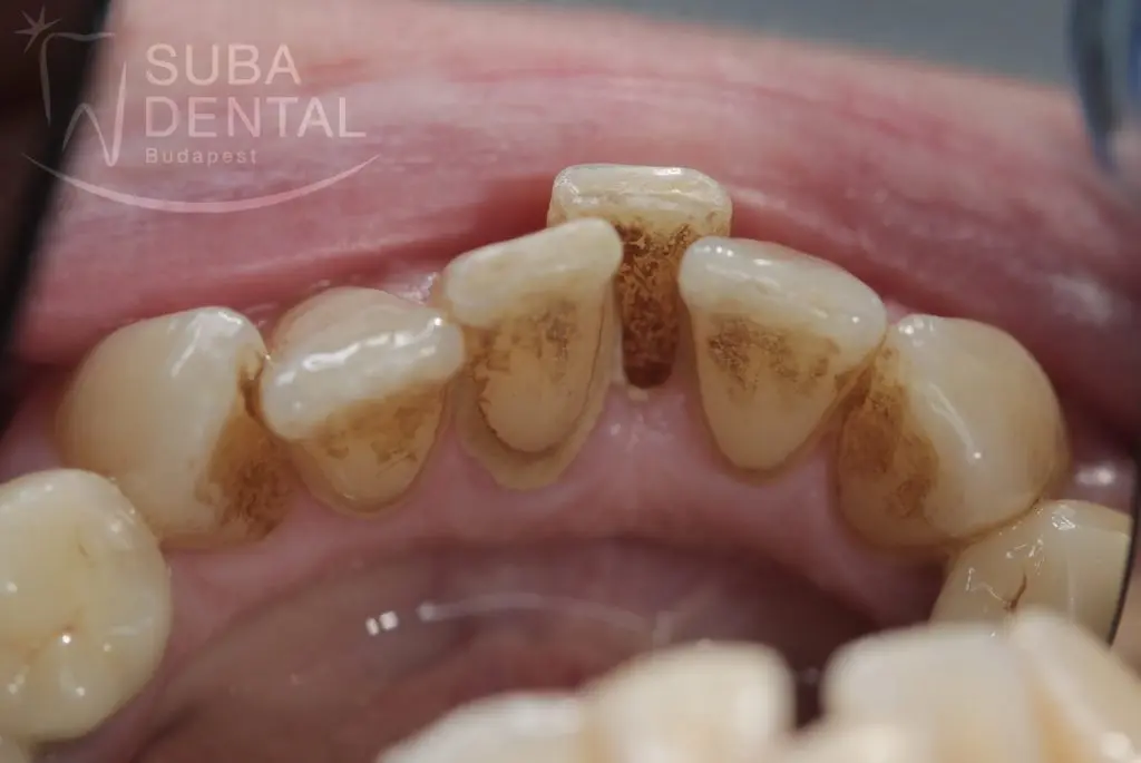 The prevention of tartar (Scaling and dental plaque)