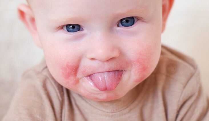 The rash in the child&#8217;s mouth is small, red: causes