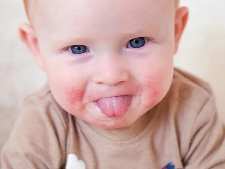 The rash in the child&#8217;s mouth is small, red: causes