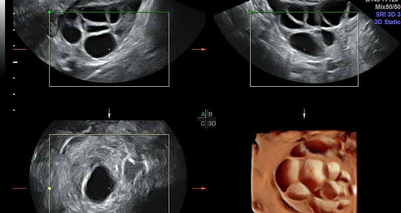 The size of the ovaries is normal in women by ultrasound