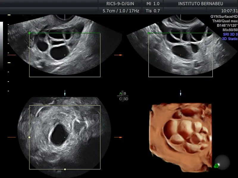 The size of the ovaries is normal in women by ultrasound