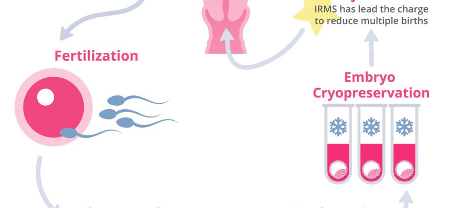 As etapas da fecundación in vitro (FIV)
