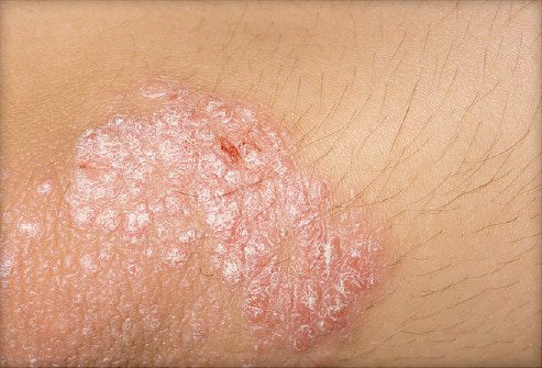 The symptoms of psoriasis