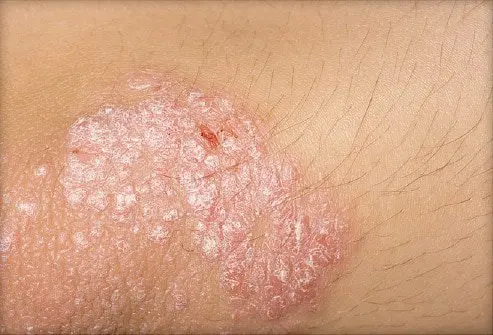 The symptoms of psoriasis