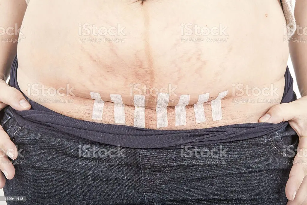 The woman showed how the stomach looks like ten days after the cesarean