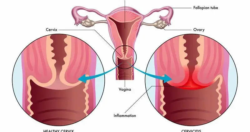 This is what is behind vaginal itching