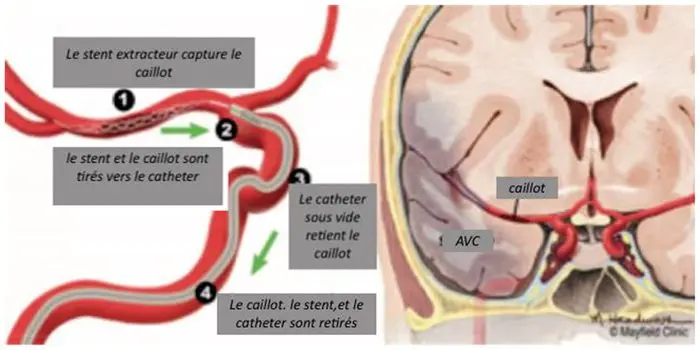 Thrombectomie