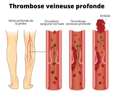 Thrombophilie