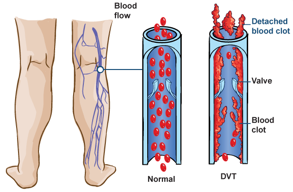 thrombosis disease how to protect yourself