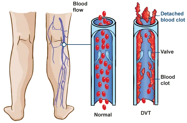 thrombosis disease how to protect yourself