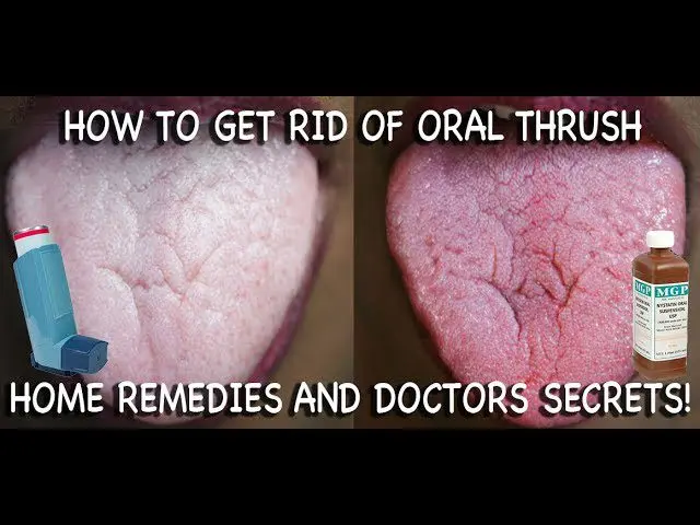 Thrush cream: how to treat candidiasis? Video