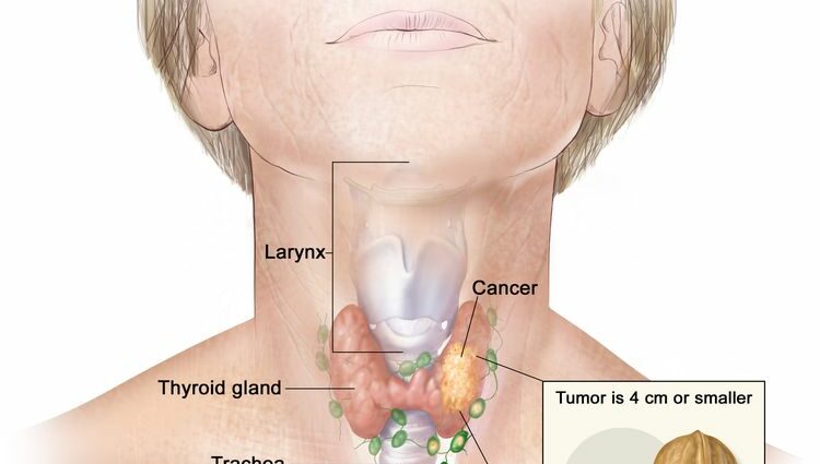 Canser y thyroid: beth ydyw?