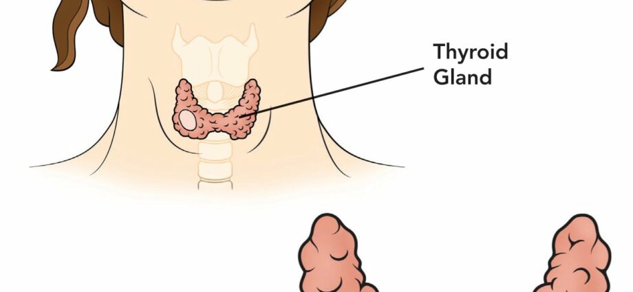 Thyroid nodule &#8211; Our doctor&#8217;s opinion