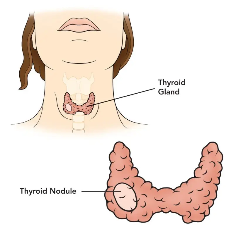 Thyroid nodule &#8211; Our doctor&#8217;s opinion