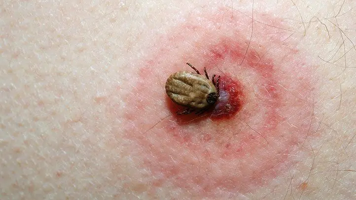 Ticks what to do when bitten