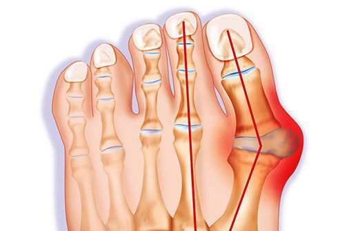 Toe bones: how to get rid of