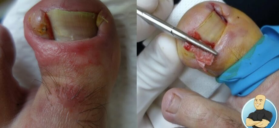 Toenail abscess: treatment. Video