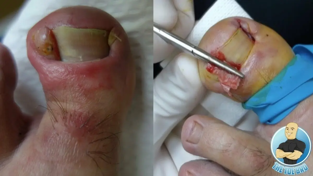 Toenail abscess: treatment. Video