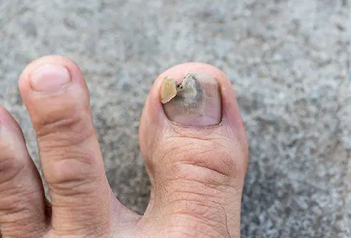 Toenail pulled out: what to do?