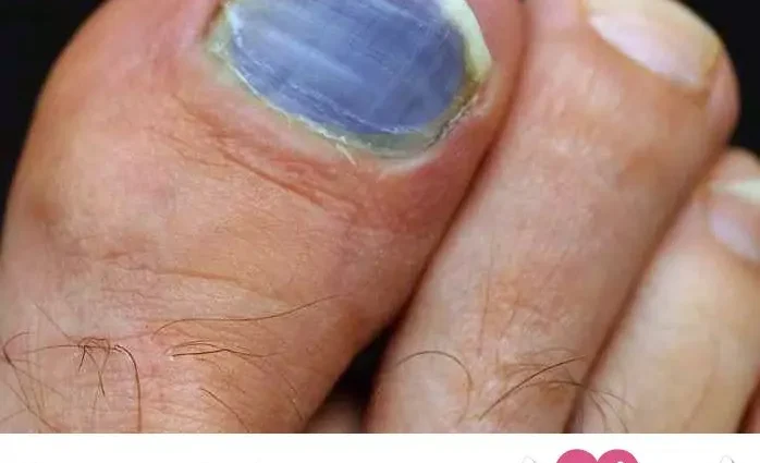Toenail turned blue: reasons