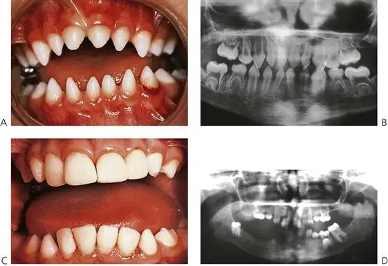 Tooth anomalies: how to treat?