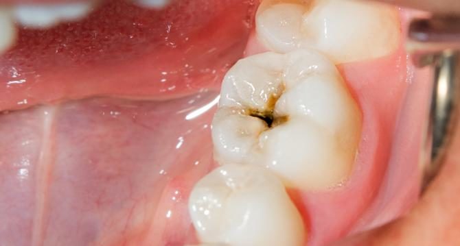 虫歯：虫歯について知る必要があるすべて