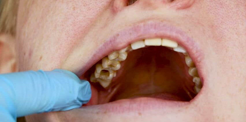 Tooth hole treatment. Video