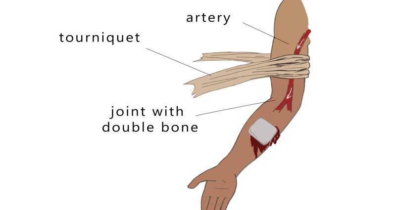 Tourniquet tourniquet: when and why is it used?