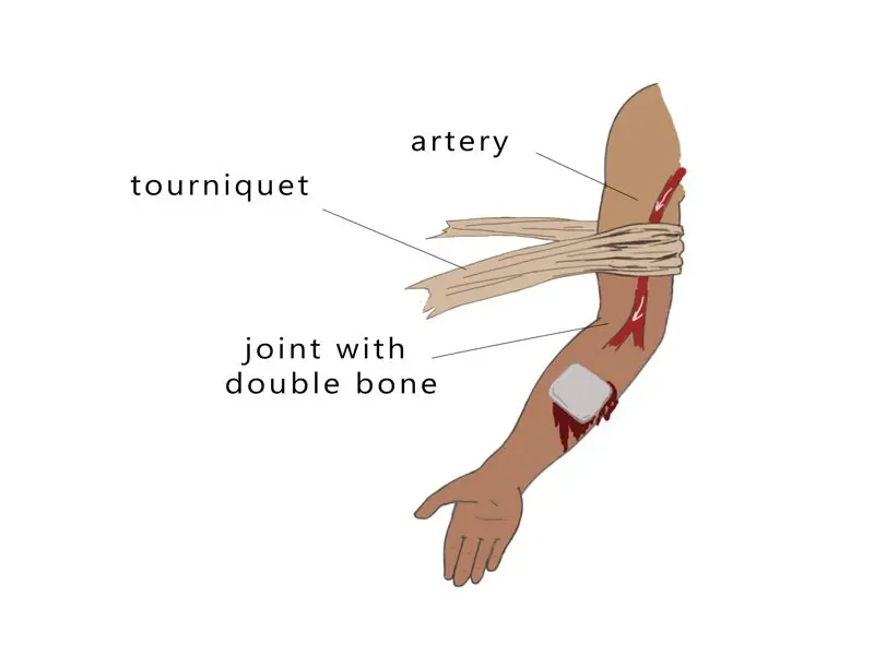 Tourniquet tourniquet: when and why is it used?